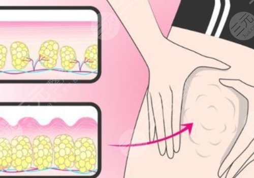 小腿吸脂恢复期要多久?有效果吗?