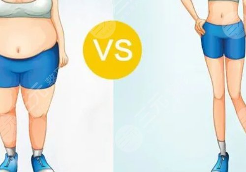 小腿吸脂恢复期要多久?有效果吗?