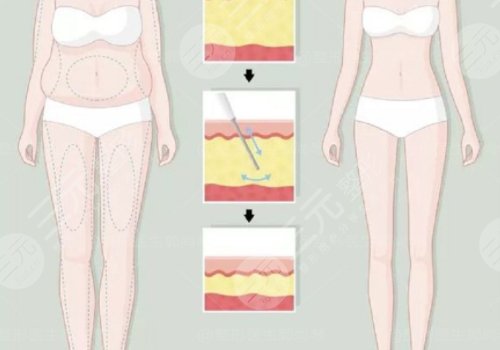 小腿吸脂恢复期要多久?有效果吗?