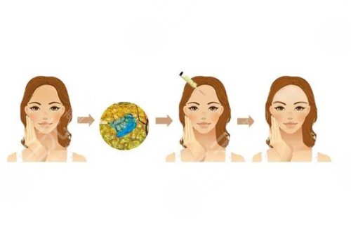 郑楚蓉做脂肪怎么样？