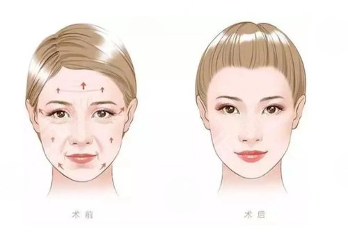 郑楚蓉做脂肪怎么样？