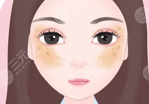 激光祛斑会不会反弹？需要做几次？