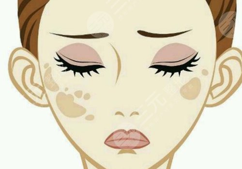 激光祛斑会不会反弹？需要做几次？