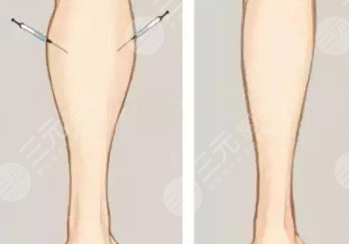 小腿吸脂后多久可以正常走路?