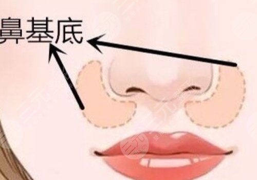 鼻基底注射玻尿酸有危险吗?
