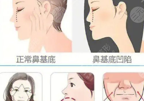 鼻基底注射玻尿酸有危险吗?