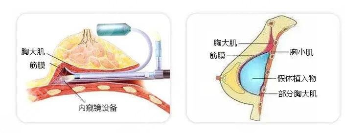 傲若拉假体价格多少钱2023?
