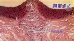 疤痕疙瘩的缓解方法有哪些？分享5种常见祛疤方案，必看科普！