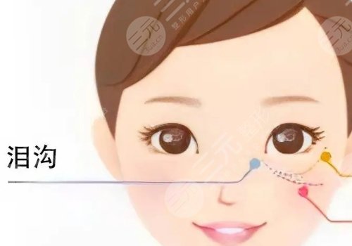 小拉皮手术可以去泪沟和法令纹吗？