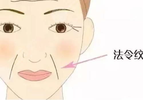 小拉皮手术可以去泪沟和法令纹吗？