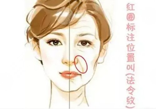 小拉皮手术可以去泪沟和法令纹吗？