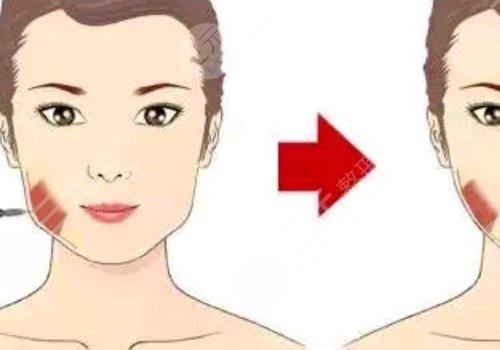 注射瘦脸会反弹吗？