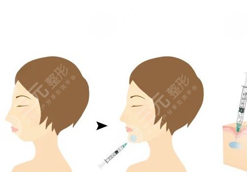 玻尿酸丰下巴一般需要几支？