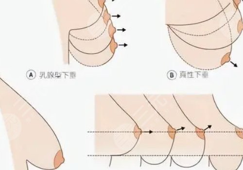 乳房悬吊术可以维持多久?
