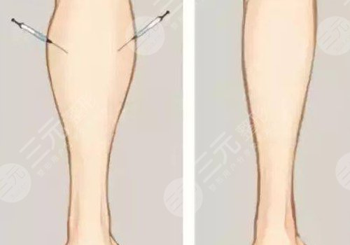 腿部吸脂手术有什么危害？