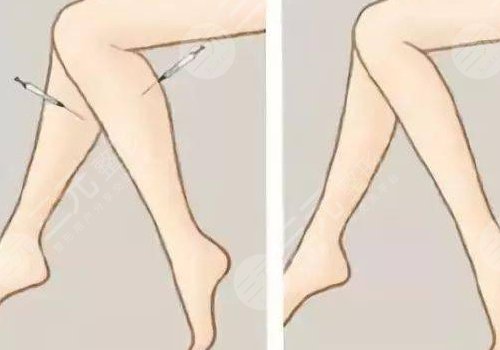 腿部吸脂手术有什么危害？