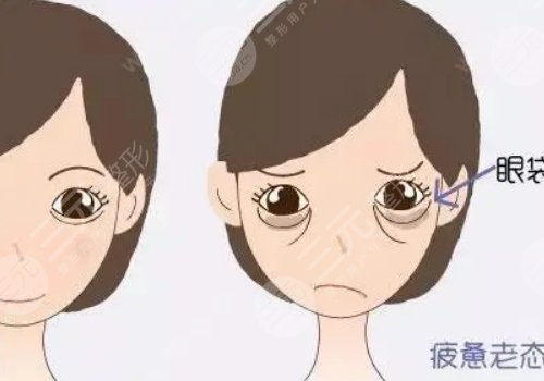 眼袋是怎么产生的？如何消除眼袋？