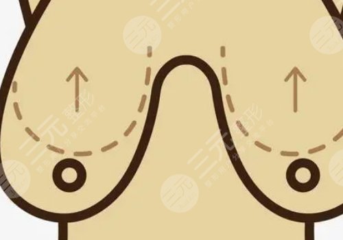 曼托隆胸是什么材质的？多久变软？