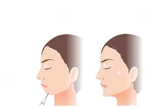 艾莉薇传奇玻尿酸维持多久？