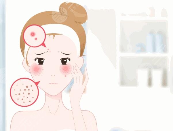 激光祛痘需要多长时间才能看到效果?