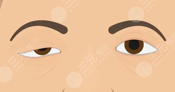 上睑下垂矫正手术一般多少钱一次?