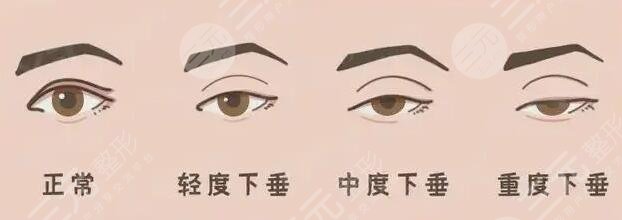 上睑下垂矫正手术一般多少钱一次?