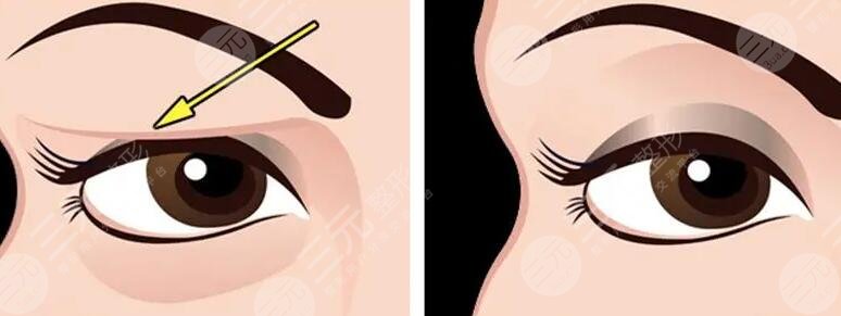 上睑下垂矫正手术的价格范围