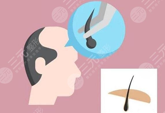 毛发种植的费用是多少2023？价格影响根源所在，30秒速览~