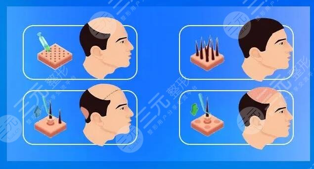 影响植发价格选择因素