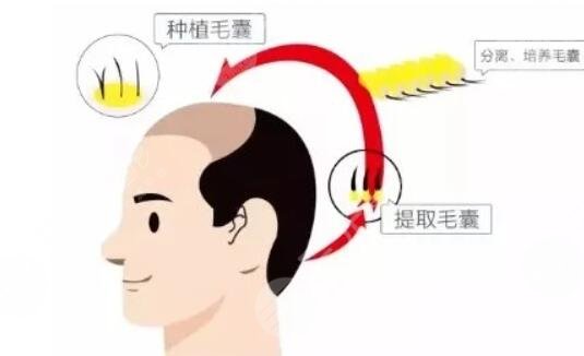 植发的具体操作
