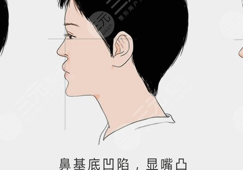 珊瑚骨填充鼻基底的价格