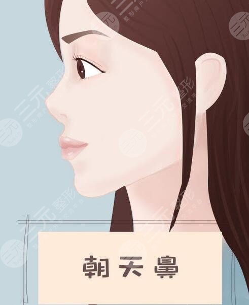 朝天鼻手术需要多少钱？