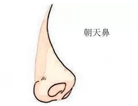 朝天鼻手术的操作原理