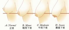 下垂胸怎么矫正？3种有用方案分享，手术重塑娇俏美胸！
