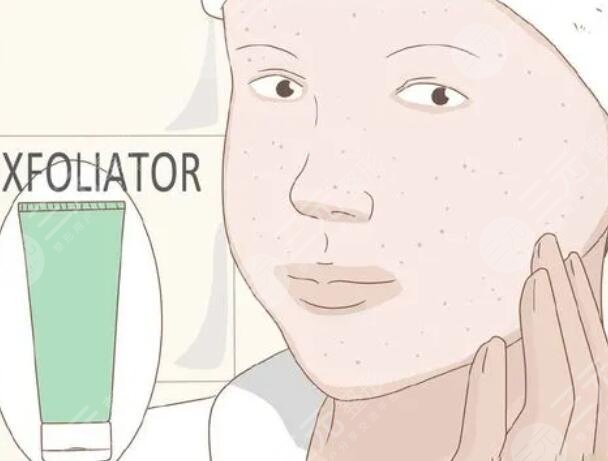 医美去角质的方法——如何选择适合自己的医美方式