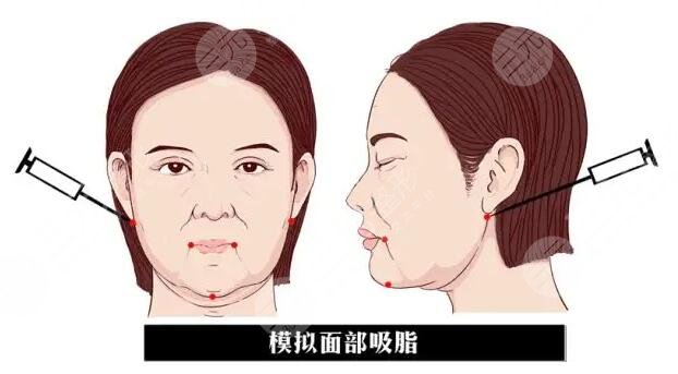 面部抽脂