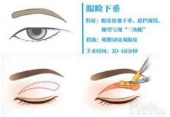 下垂眼睑缓解方法科普！费用多少钱，术前参考！