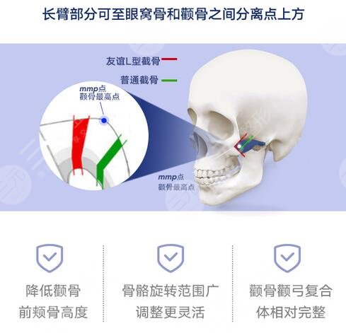 颧骨内推手术