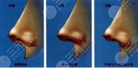 硅胶假体隆鼻价格大概多少钱?告诉你这3点关键因素影响着价位!