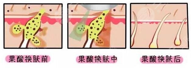 果酸换肤的注意事项