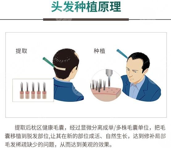 脱发 植发