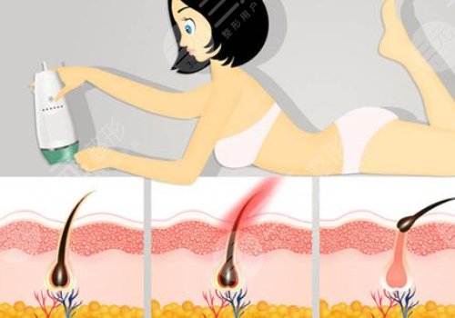 激光脱毛几次能永久脱毛？