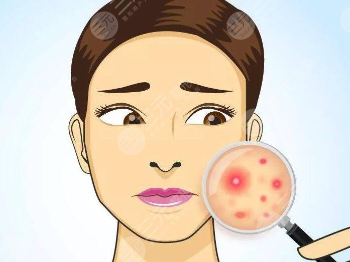缓解青春痘时需要注意以下几点：