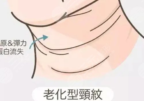 颈纹怎么消除?