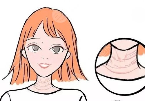 颈纹怎么消除?