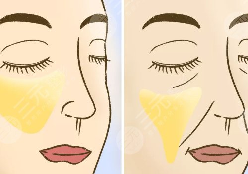 7d聚拉提美容的功效和副作用有哪些?