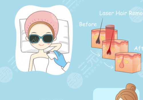 激光脱毛和冰点脱毛有什么区别？