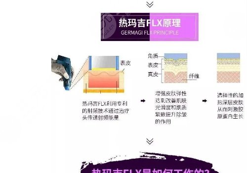 fotona4D和热玛吉的区别|哪个效果好?