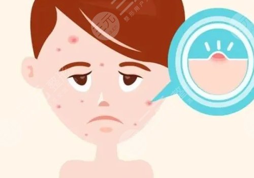脸上痘坑怎么去除？