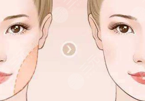 杭州时光下颌角磨骨怎么样?